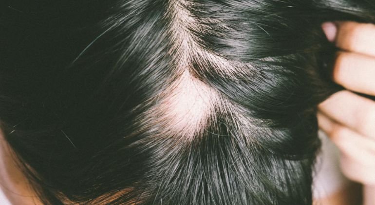 Hair Loss by Hair Type Does It Look Different