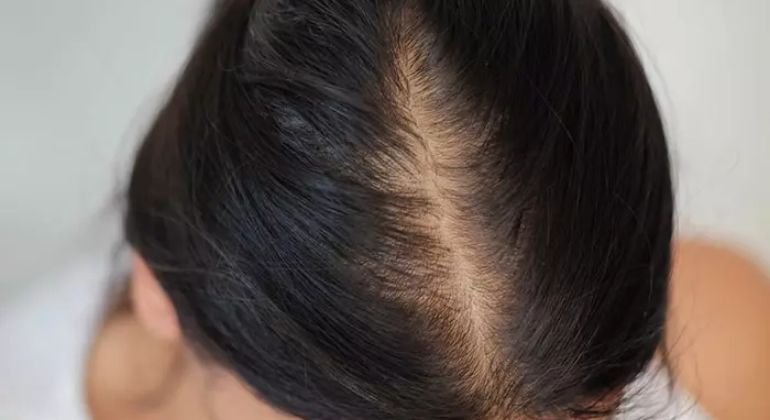 What Does Hair Breakage at the Crown Look Like