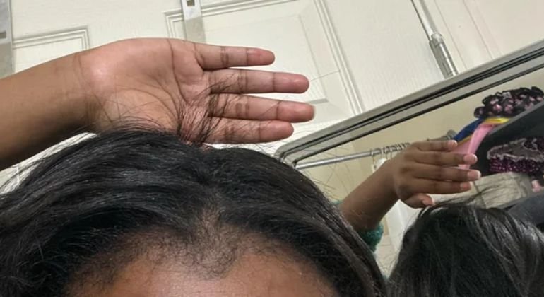 Why Is My Hair Breaking at the Top of My Head