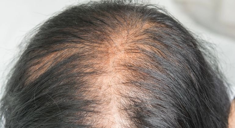 Genetics Can Cause Gradual Hair Thinning