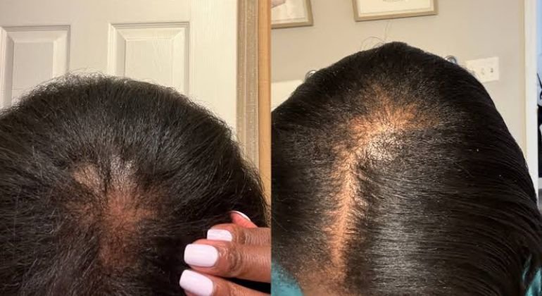 Hair Loss More Common, and Less Discussed, Than Most People Think